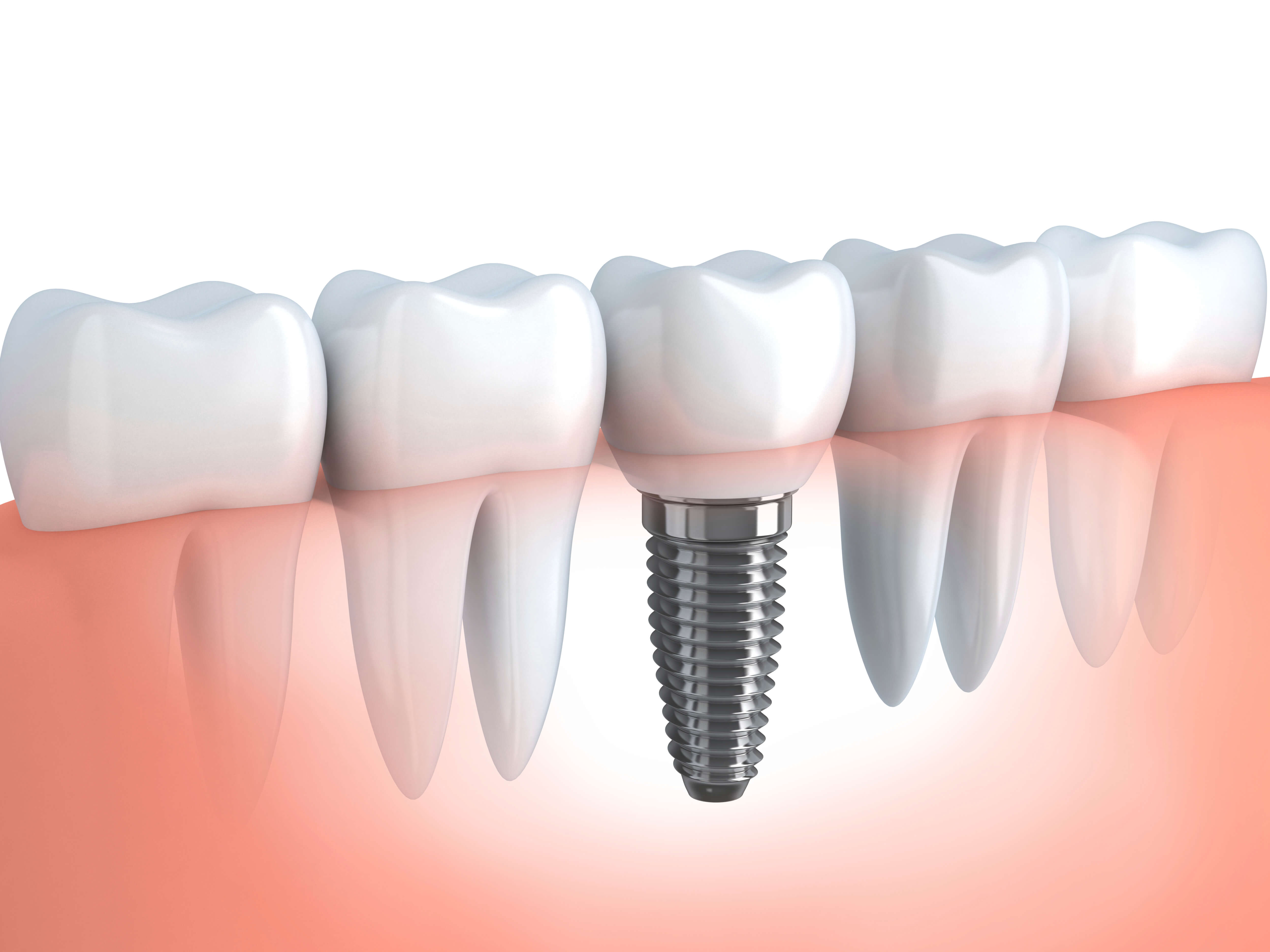 Combien vous coûtera votre implant dentaire ?